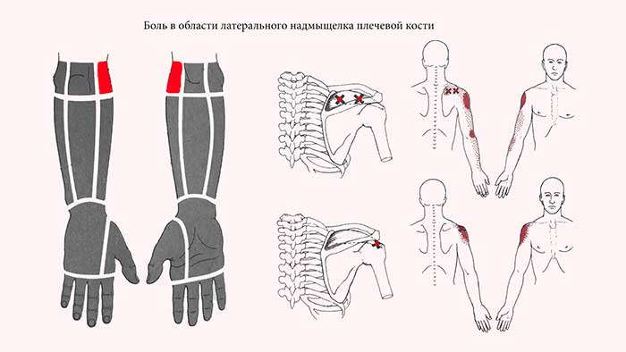 Боль в области латерального надмыщелка плечевой кости