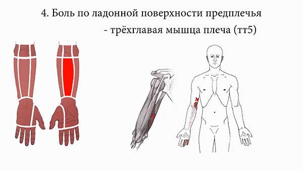 триггеры трёхглавой мышцы плеча
