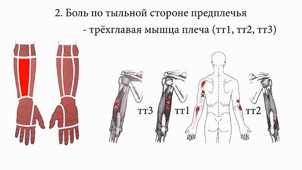 трёхглавая мышца плеча
